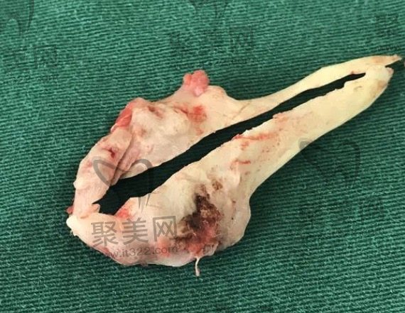 下颌角切除手术的注意事项 下颌角切除手术的注意事项