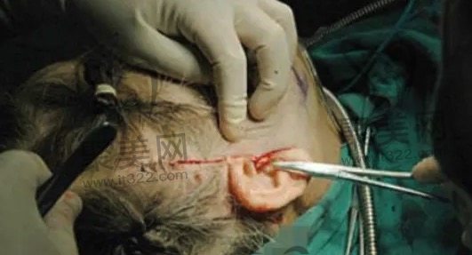 面部拉皮手术好不好 面部拉皮手术好不好