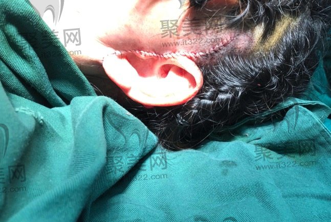 面部拉皮手术价格贵吗 面部拉皮手术价格贵吗