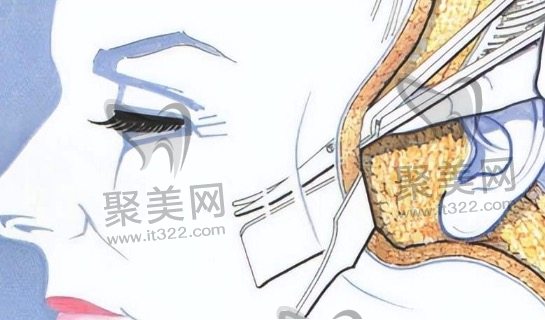 面部拉皮手术适合什么年龄段 面部拉皮手术适合什么年龄段