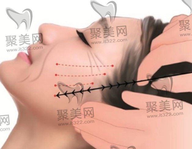 面部拉皮手术费用是多少钱 面部拉皮手术费用是多少钱