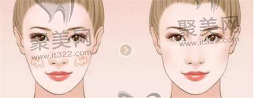 面部填充 面部填充