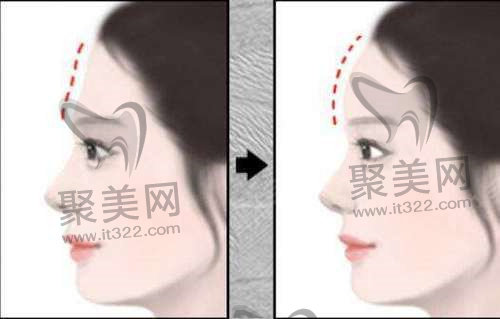 面部填充 面部填充