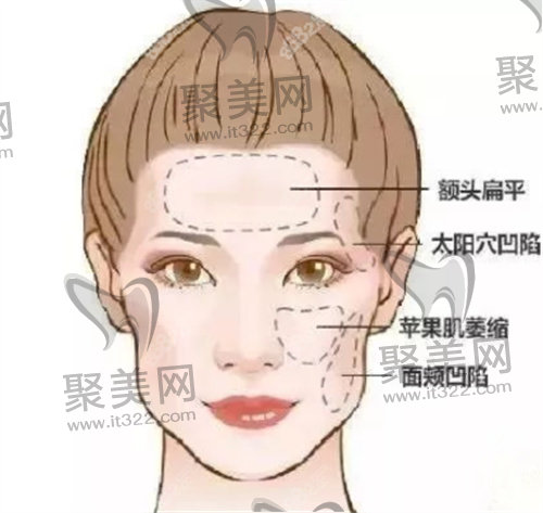 面部填充 面部填充