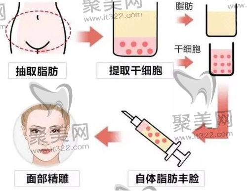 面部填充 面部填充