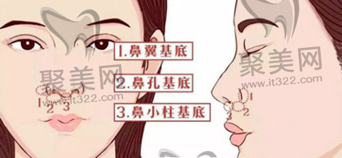 鼻基底填充 鼻基底填充