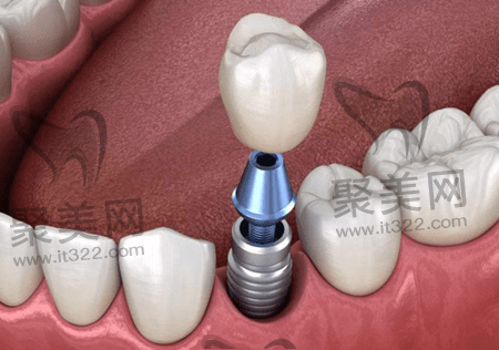 法国安卓健种植体 法国安卓健种植体