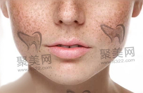 黄褐斑 黄褐斑
