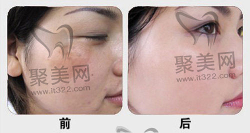 激光祛斑前后 激光祛斑前后