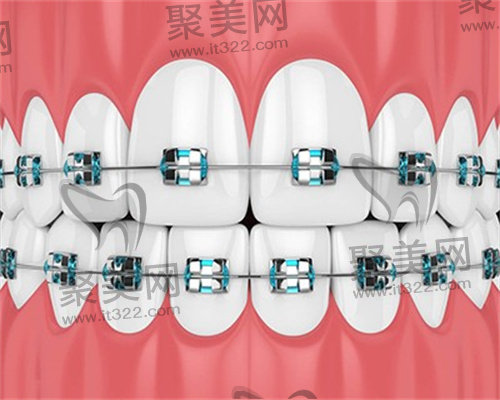 牙齿正畸 牙齿正畸