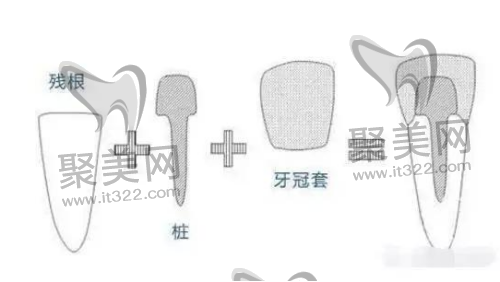 牙齿打桩做牙冠费用 牙齿打桩做牙冠费用
