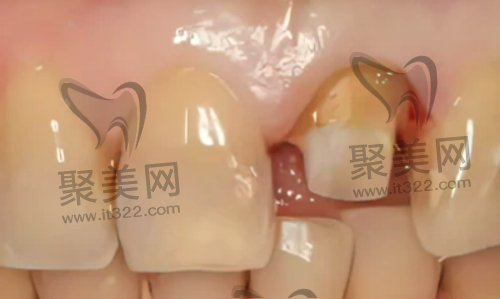 牙齿打桩准备 牙齿打桩准备