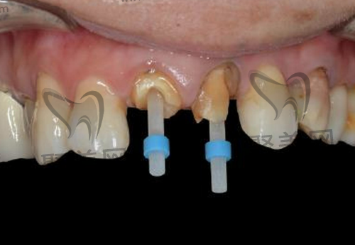 牙齿打桩 牙齿打桩