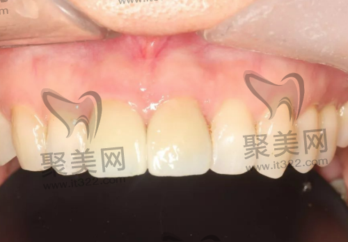 牙齿打桩修复完成 牙齿打桩修复完成