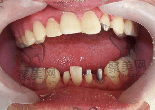 牙齿打桩需要注意什么 牙齿打桩需要注意什么