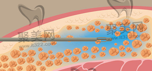 自体脂肪移植 自体脂肪移植