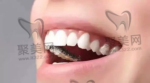 舌侧矫正 舌侧矫正