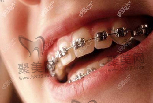 金属托槽矫正 金属托槽矫正