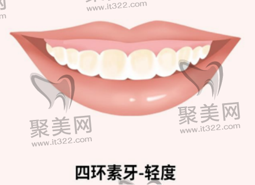 轻度四环素牙 轻度四环素牙