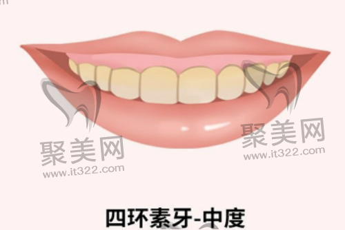 中度四环素牙 中度四环素牙