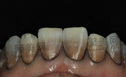 四环素牙 四环素牙