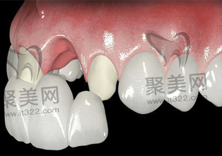 全瓷牙 全瓷牙