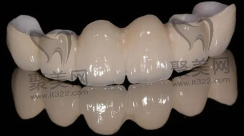 全瓷牙 全瓷牙