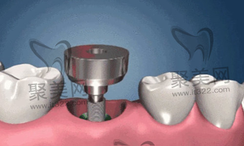 种植牙 种植牙