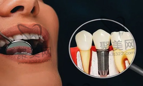 种植牙 种植牙