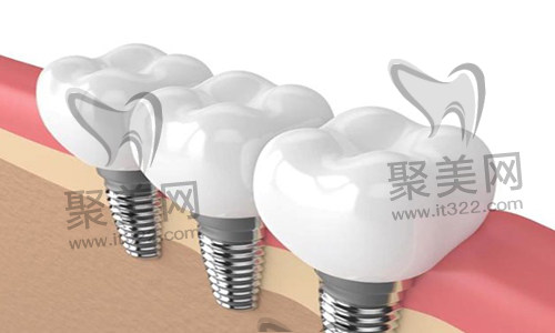 种植牙 种植牙