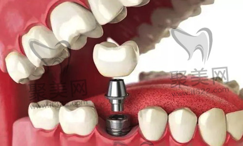 种植牙 种植牙