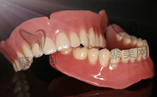 吸附性义齿贵吗 吸附性义齿贵吗