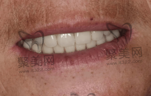 吸附性义齿体验感 吸附性义齿体验感