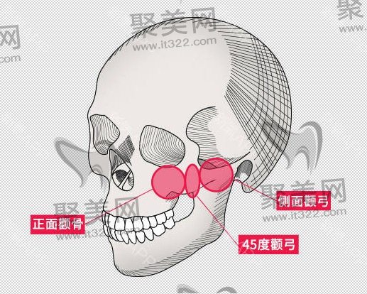 颧骨内推要花多少钱 颧骨内推要花多少钱