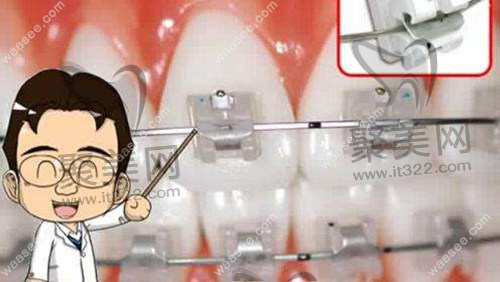 自锁托槽 自锁托槽