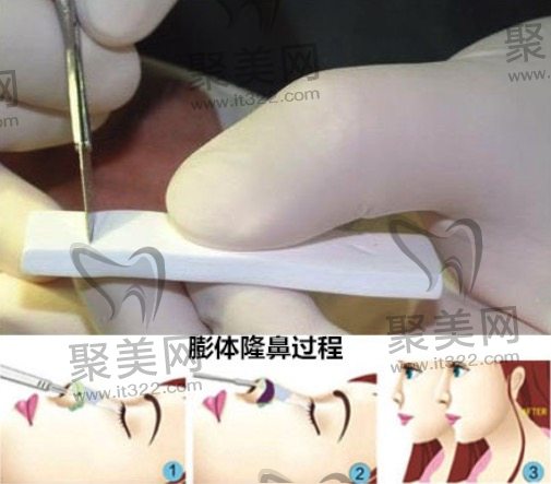 膨体隆鼻过程 膨体隆鼻过程