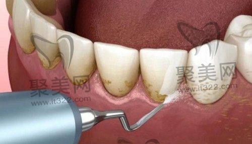 喷砂洁牙会对牙齿有伤害吗 喷砂洁牙会对牙齿有伤害吗