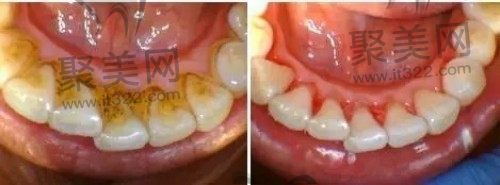 超声波洁牙 超声波洁牙