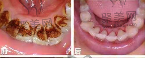 喷砂洁牙 喷砂洁牙