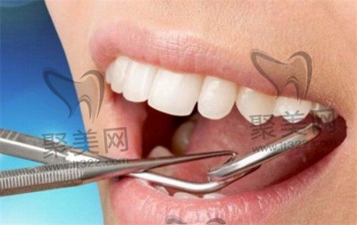 喷砂洁牙后需要注意什么 喷砂洁牙后需要注意什么