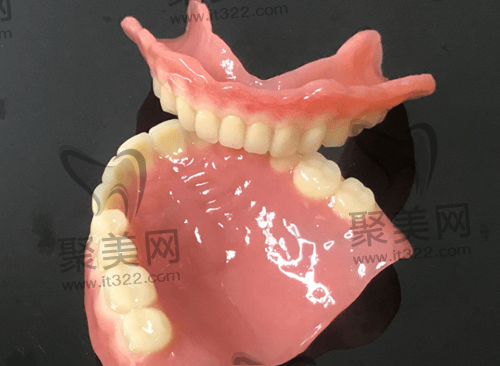 吸附性义齿 吸附性义齿