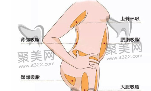 腰腹吸脂 腰腹吸脂