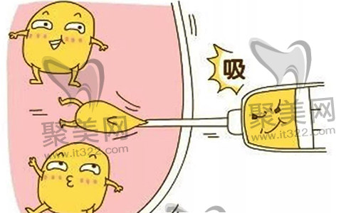 腰腹吸脂 腰腹吸脂