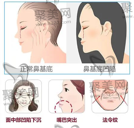 北京泛美医疗美容诊所王军高难度鼻修复技术强 北京泛美医疗美容诊所王军高难度鼻修复技术强