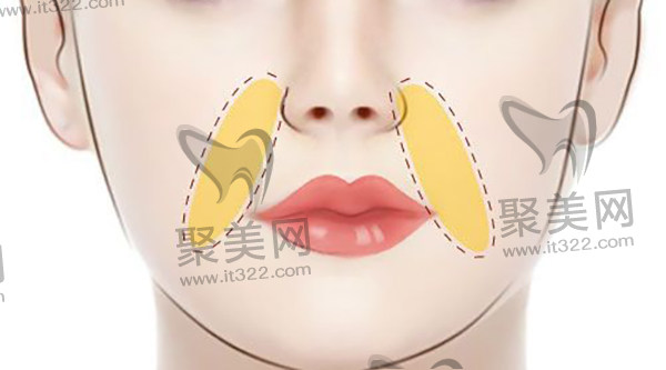 北京泛美医疗美容诊所王军院长隆鼻 北京泛美医疗美容诊所王军院长隆鼻