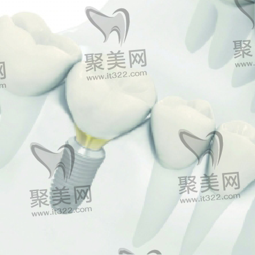 奥齿泰种植体 奥齿泰种植体