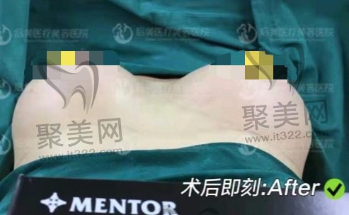 薛瑞隆胸术后即刻实例图 薛瑞隆胸术后即刻实例图