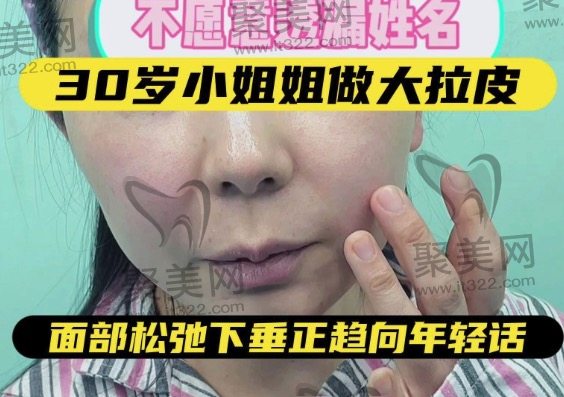 30岁做面部拉皮是否适合? 30岁做面部拉皮是否适合?