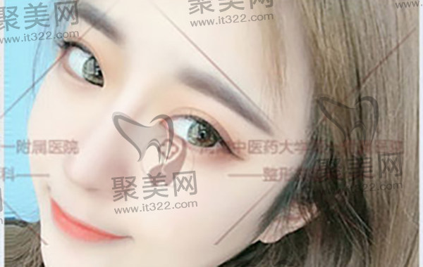 郑州葛艳娜做双眼皮怎么样 郑州葛艳娜做双眼皮怎么样