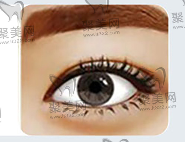 葛艳娜医生做双眼皮 葛艳娜医生做双眼皮